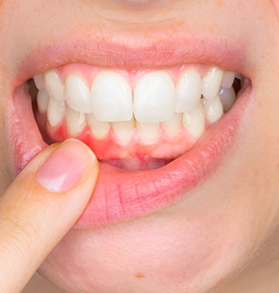 Điều Trị Viêm Nướu