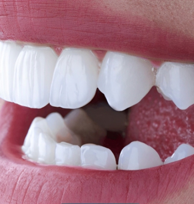 Mặt Dán Sứ Zirconia Đức