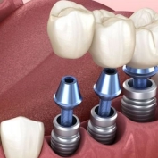 Cấy ghép implant