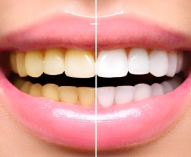 TẨY TRẮNG RĂNG LÀ GÌ? ƯU VÀ NHƯỢC CỦA TẨY TRẮNG RĂNG