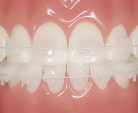 MẮC CÀI TRONG SUỐT LÀ GÌ? NHỮNG ĐIỀU LƯU Ý KHI SỬ DỤNG MẮC CÀI TRONG SUỐT?