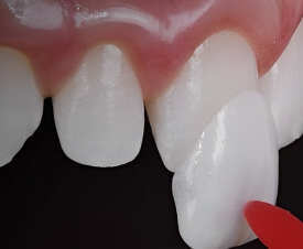 DÁN SỨ THẨM MỸ LÀ GÌ? ƯU NHƯỢC ĐIỂM CỦA BIỆN PHÁP DÁN SỨ THẨM MỸ VÀ CÁC SỰ CỔ THƯỜNG GẶP SAU KHI DÁN SỨ THẨM MỸ.