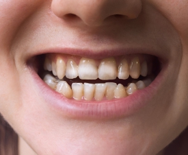 MÒN MEN RĂNG LÀ GÌ? CÁC BIỆN PHÁP PHÒNG NGỪ | NHA KHOA KIM LONG