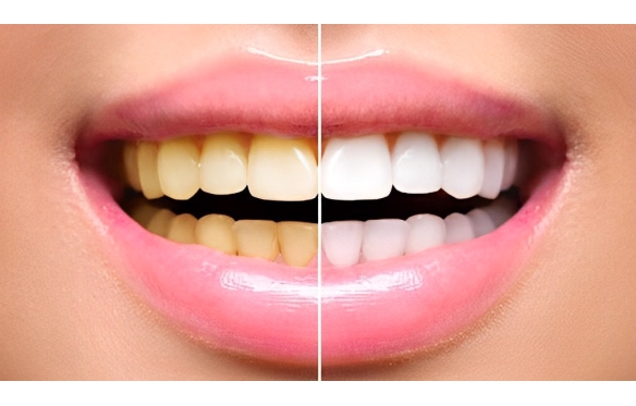 TẨY TRẮNG RĂNG LÀ GÌ? ƯU VÀ NHƯỢC CỦA TẨY TRẮNG RĂNG