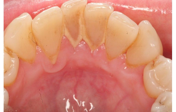 Mảng bám răng miệng, cao răng