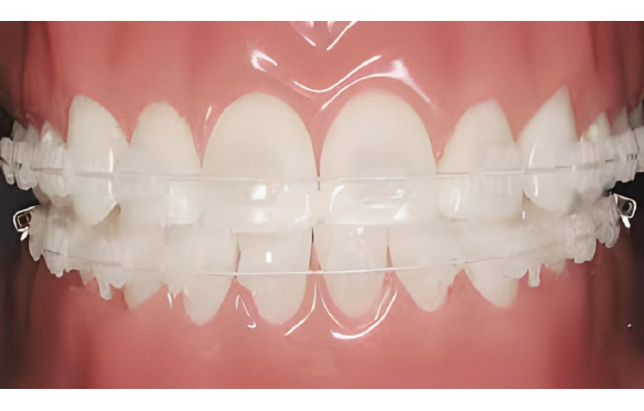 MẮC CÀI TRONG SUỐT LÀ GÌ? NHỮNG ĐIỀU LƯU Ý KHI SỬ DỤNG MẮC CÀI TRONG SUỐT?