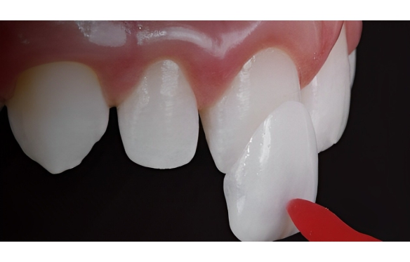 DÁN SỨ THẨM MỸ LÀ GÌ? ƯU NHƯỢC ĐIỂM CỦA BIỆN PHÁP DÁN SỨ THẨM MỸ VÀ CÁC SỰ CỔ THƯỜNG GẶP SAU KHI DÁN SỨ THẨM MỸ.