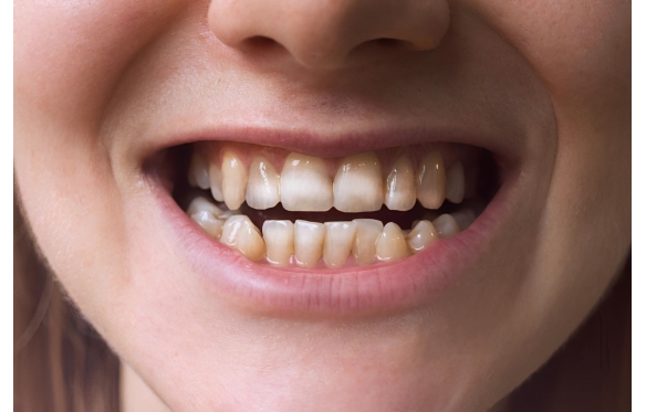 MÒN MEN RĂNG LÀ GÌ? CÁC BIỆN PHÁP PHÒNG NGỪ | NHA KHOA KIM LONG