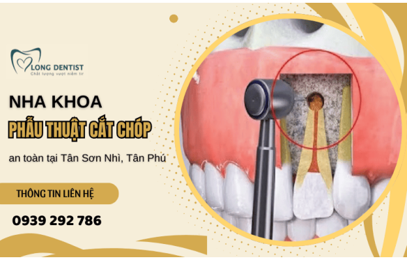 Nha khoa phẫu thuật cắt chóp an toàn và chính xác tại Tân Sơn Nhì, Tân Phú 