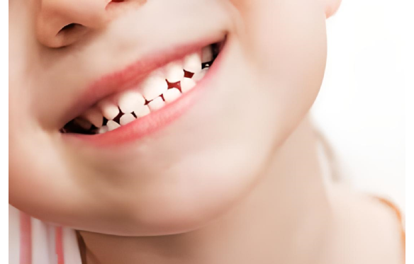 SỰ QUAN TRỌNG CỦA VIỆC CHĂM SÓC RĂNG SỮA