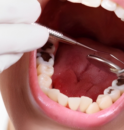 Điều Trị Tuỷ Răng Người Lớn