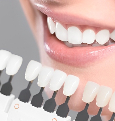 Tẩy Trắng Răng Tại Phòng Khám
