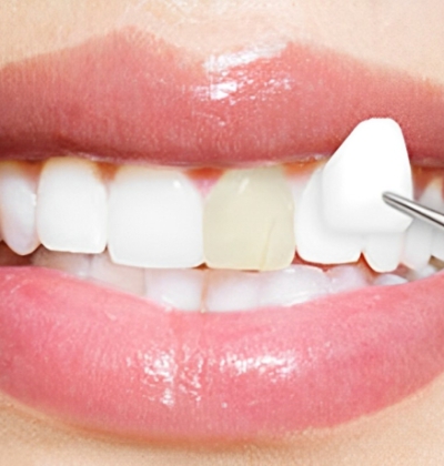 Mặt Dán Sứ Veneer