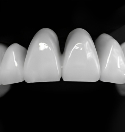 Răng Toàn Sứ CERCON HT - ĐỨC