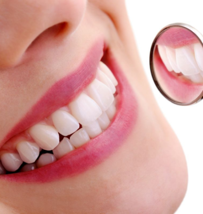 Mặt Dán Sứ Cercon HT